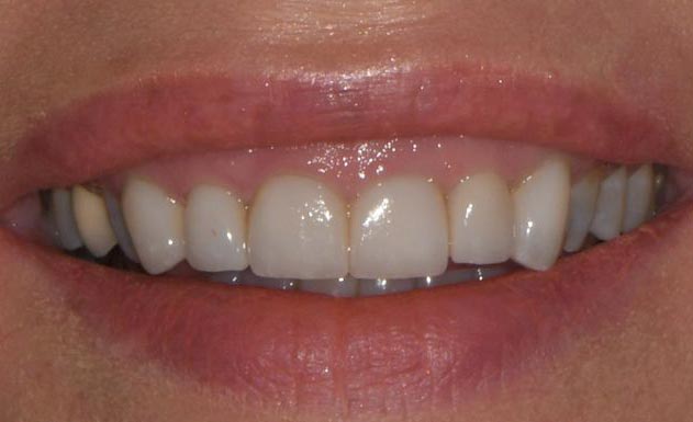 A patient with veneers
