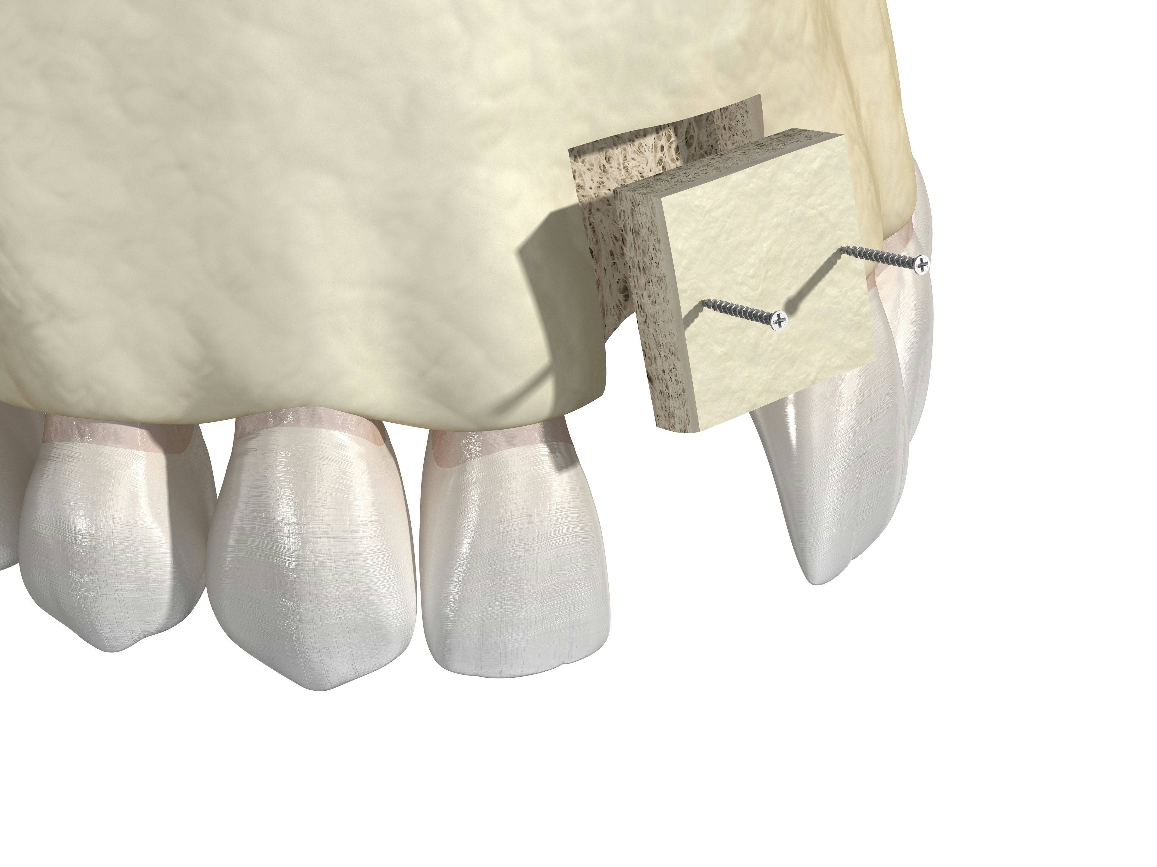 Bone Grafting
