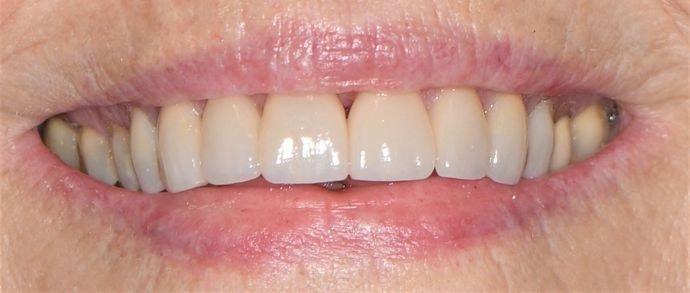 Case 3 after porcelain veneer procedure