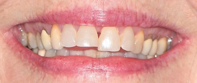 Case 3 before porcelain veneer procedure