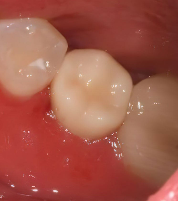 After Dental Crowns