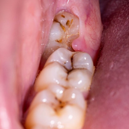 decayed teeth with cavities