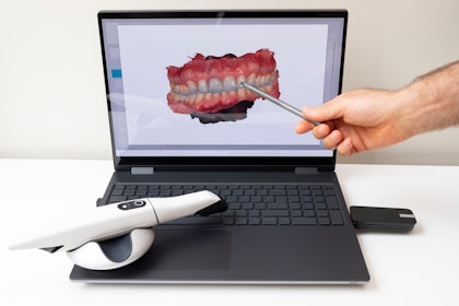 intraoral scanner