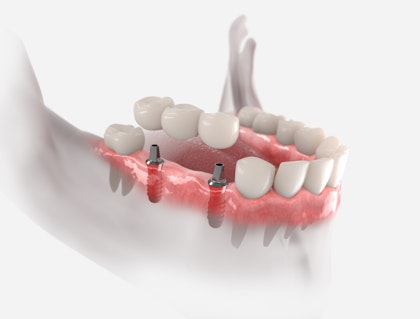 implant-supported bridge