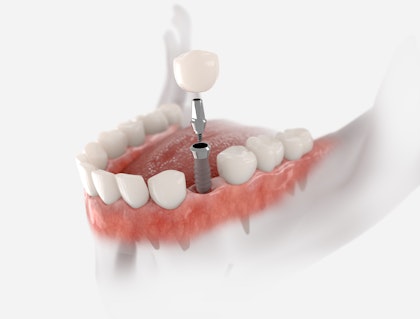 implant-supported crown