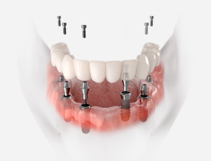 implant-supported dentures