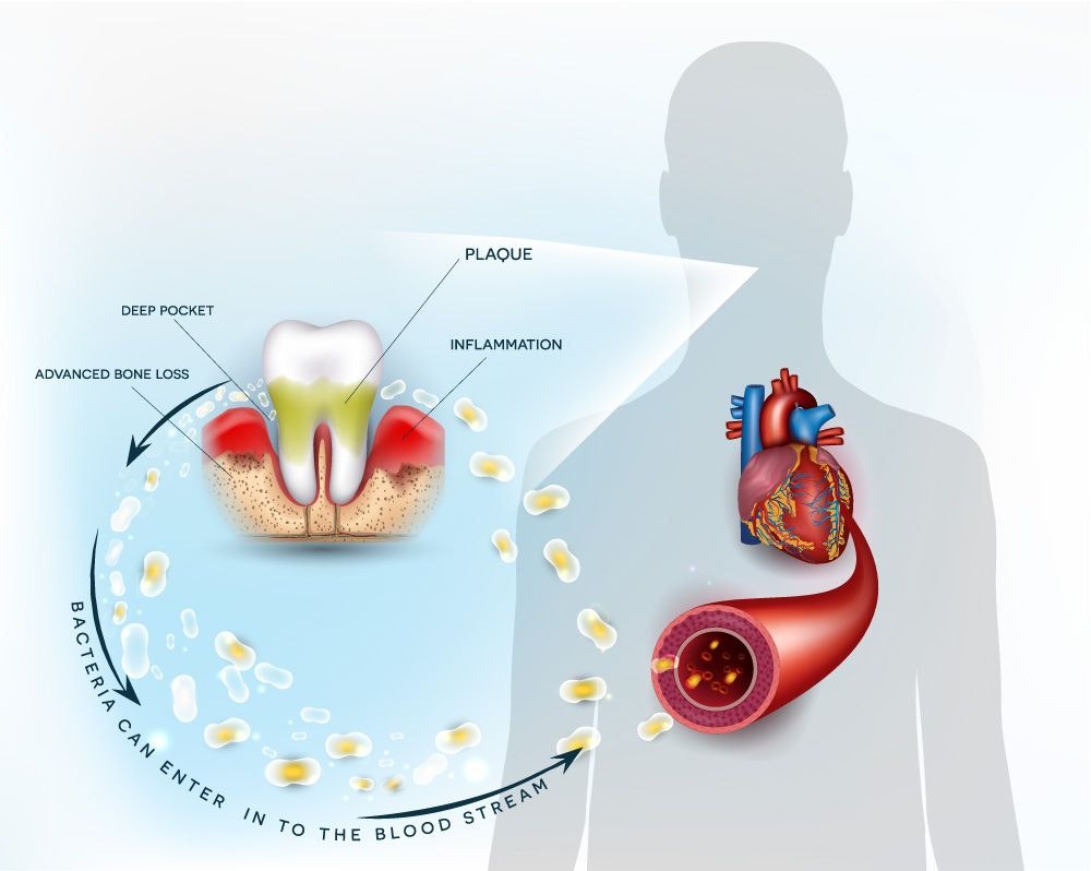 Graphic demonstrating how oral health impacts cardiac health