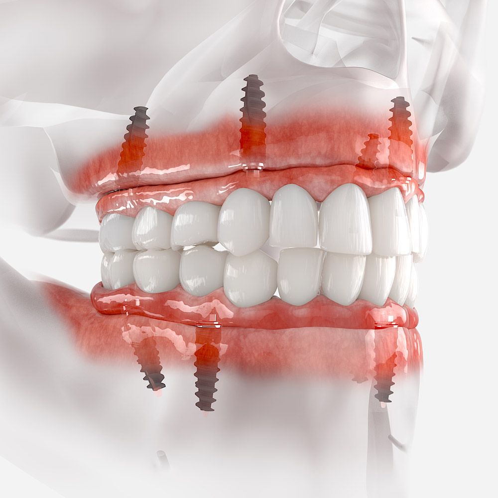 Denture implants