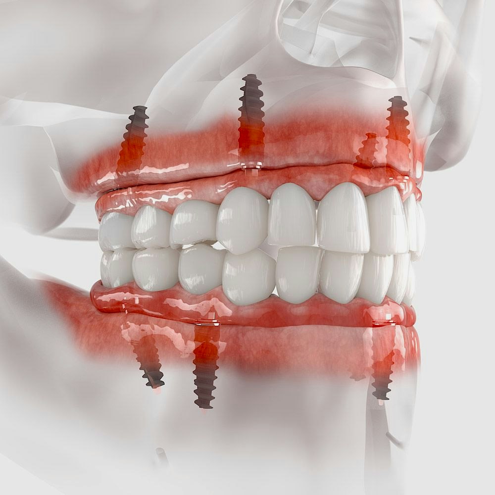 Denture implants