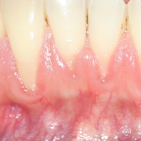 Gum Recession