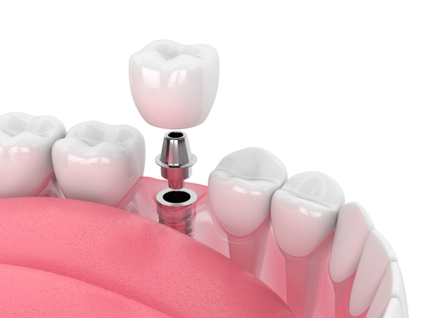 Implant, abutment and crown