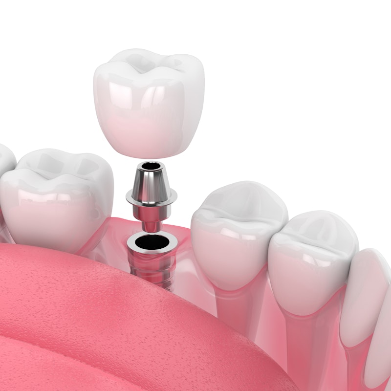 Implant, abutment and crown