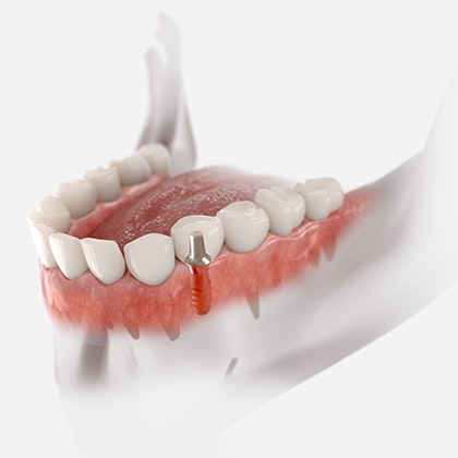 implant-supported crown
