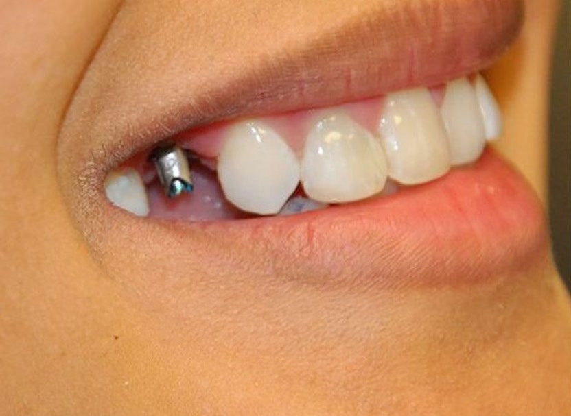 Abutment installed for implant