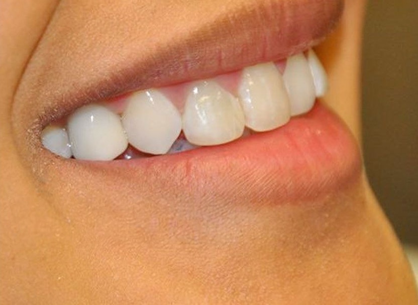 Healthy smile after implant