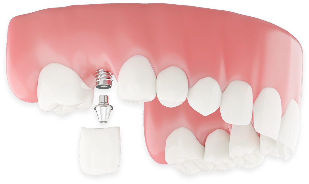 dental implant diagram