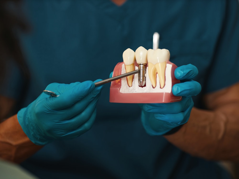 Gloved hands holding dental model demonstrating placement of a single tooth implant