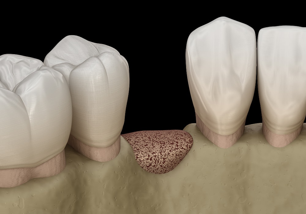 3D rendering of teeth and jawbone showing a gap at a tooth extraction site