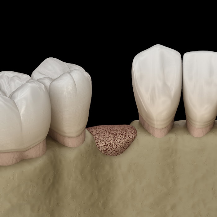 3D rendering of teeth and jawbone showing a gap at a tooth extraction site