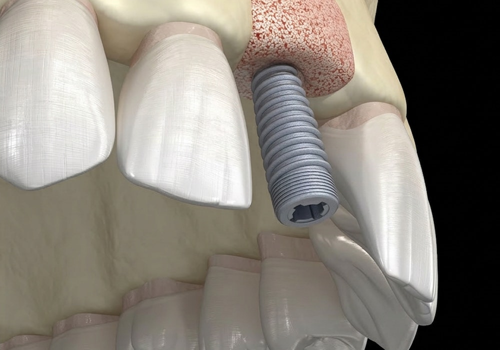 3D rendering of a dental implant placed in a bone graft site in the jaw