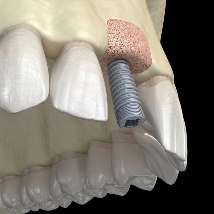 3D rendering of a dental implant placed in a bone graft site in the jaw