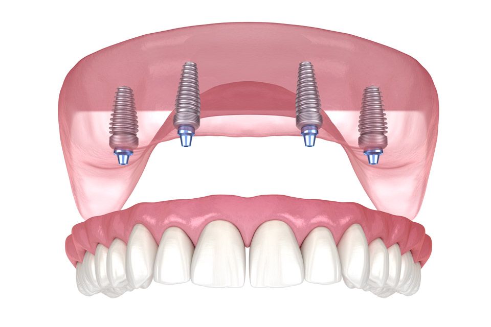 All-on-4 Dentures
