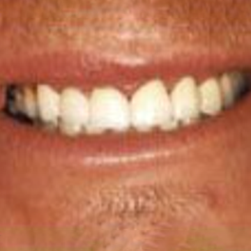 After veneers