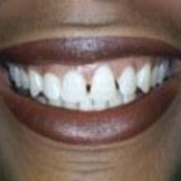 Before veneers