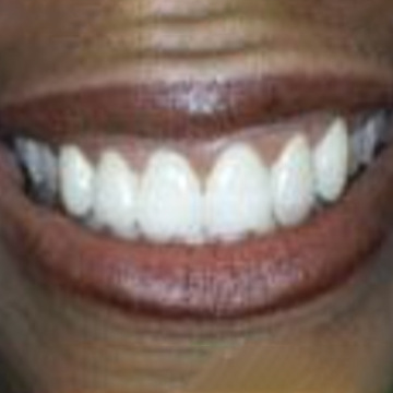 After veneers