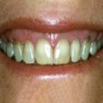 Before veneers