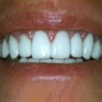After veneers
