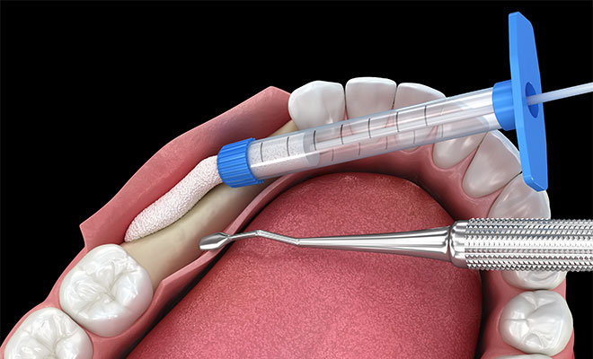 Illustration of a bone grafting