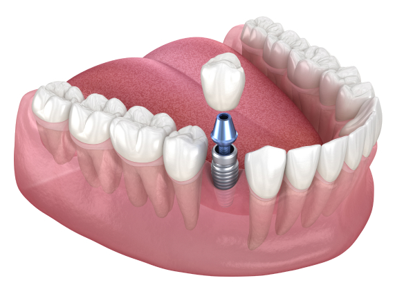 Implant crown