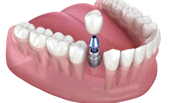 Implant crown