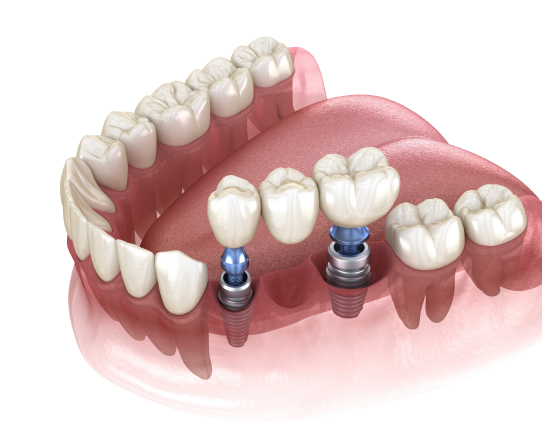 Implant bridge