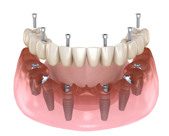 Implant dentures