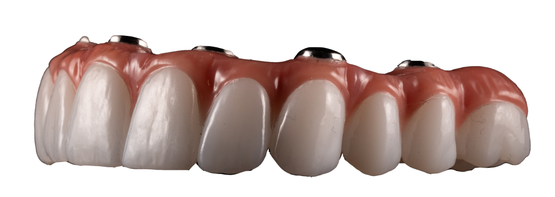Implant denture