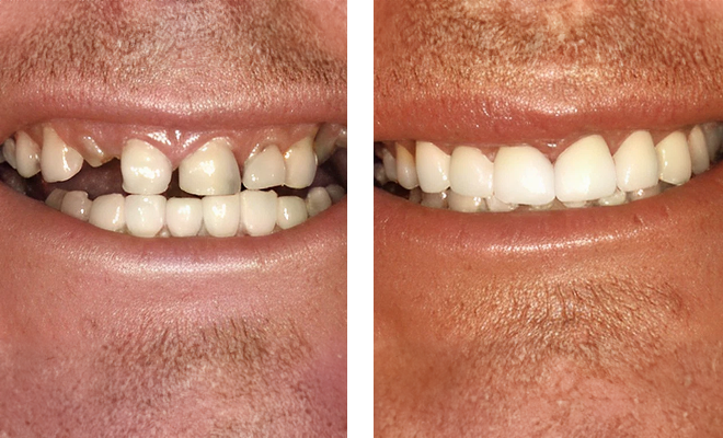 Before and after veneers