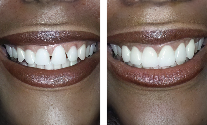 Before and after dental veneers