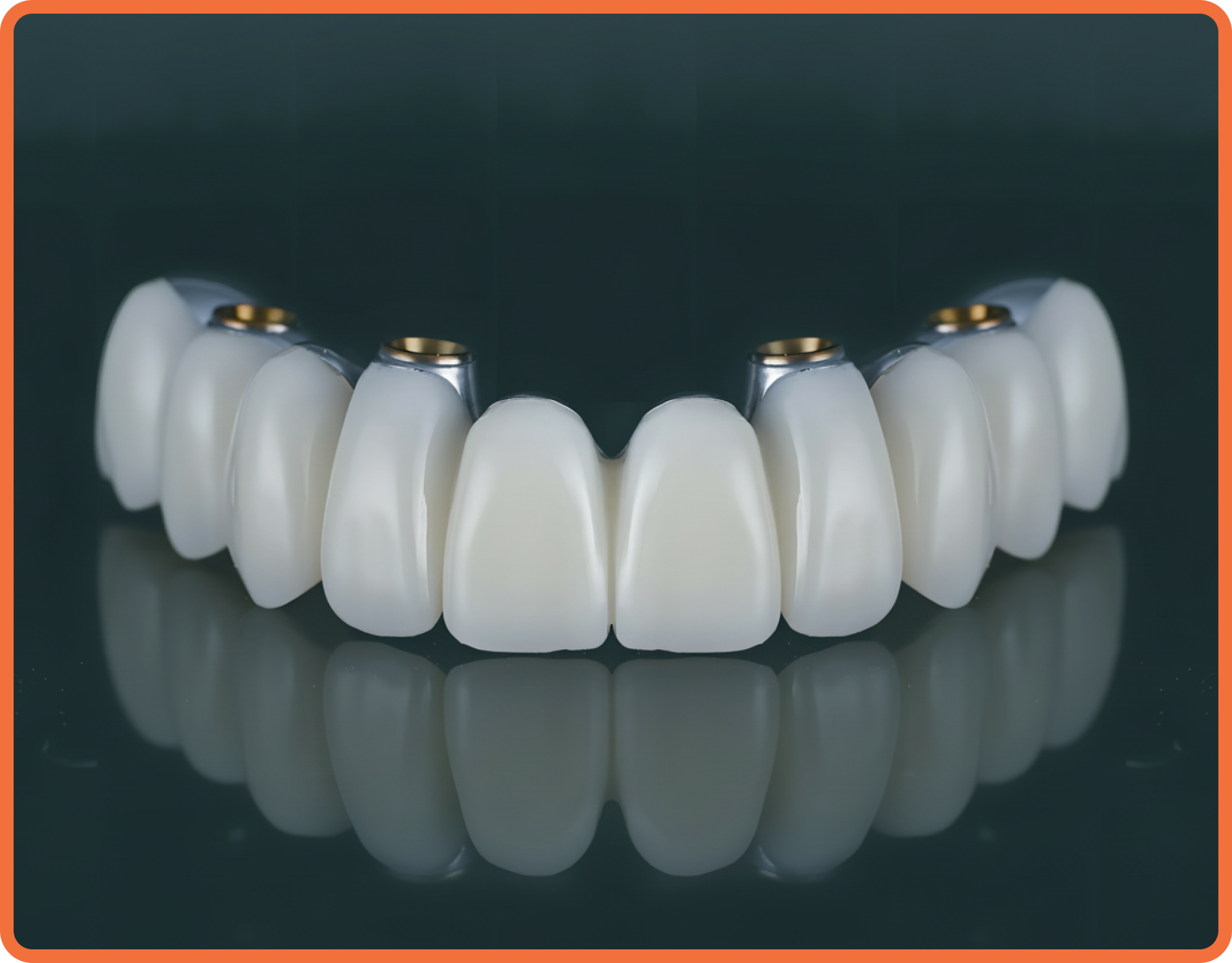 Implant denture