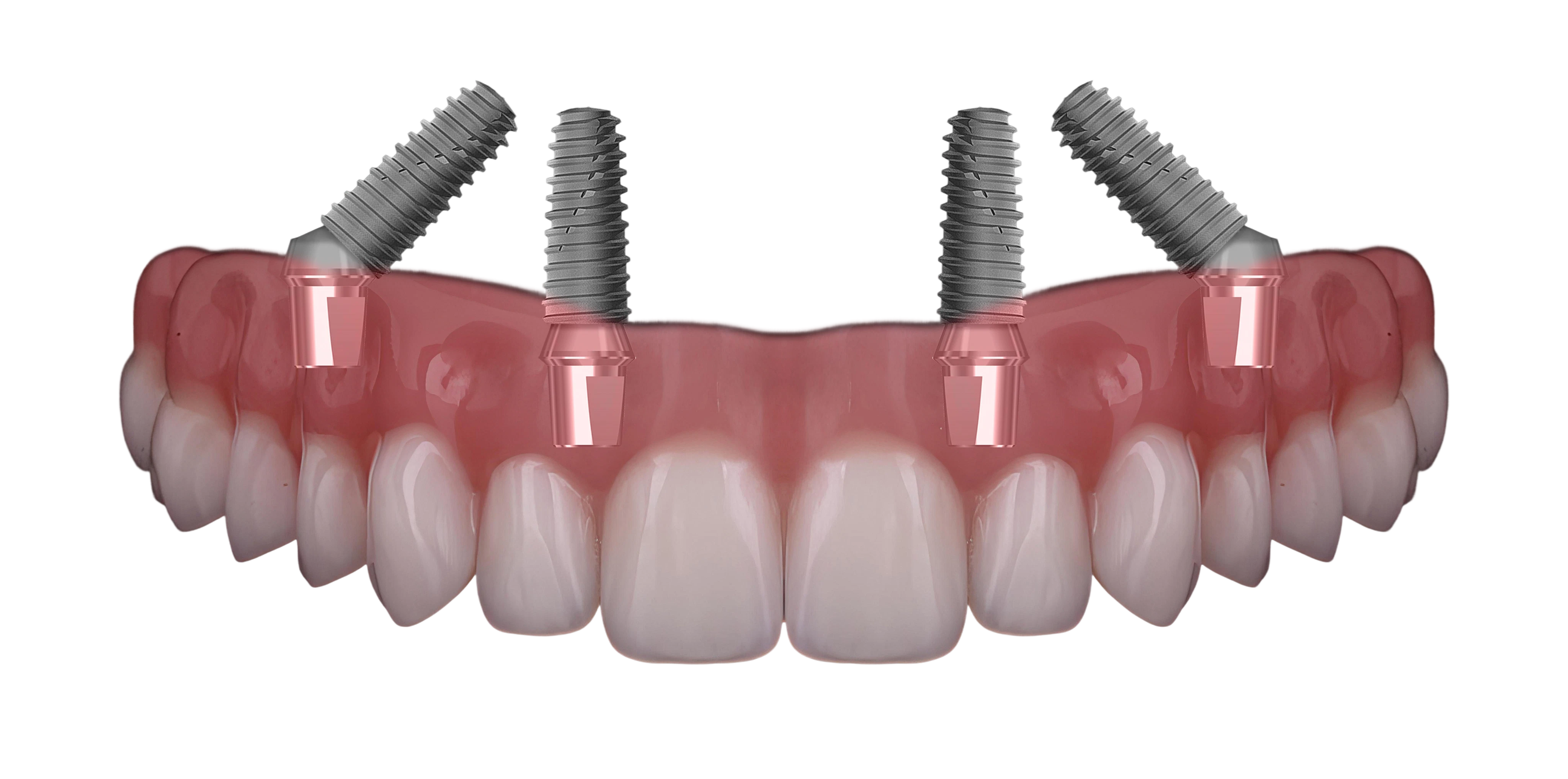 All-on-4 denture