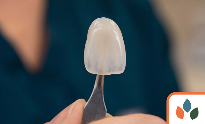 close-up of a dental veneer