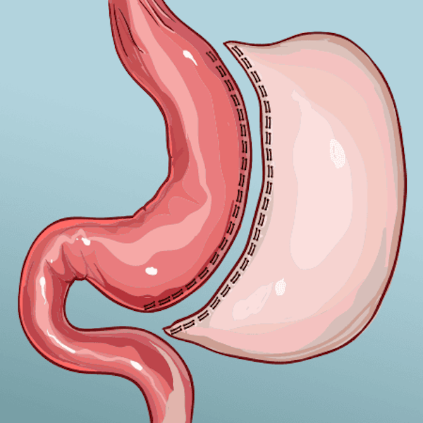 Gastric Sleeve illustration