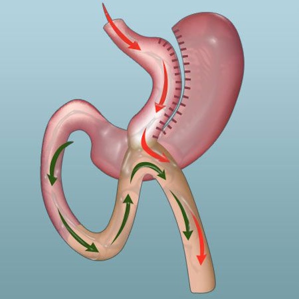 Mini Gastric Bypass illustration