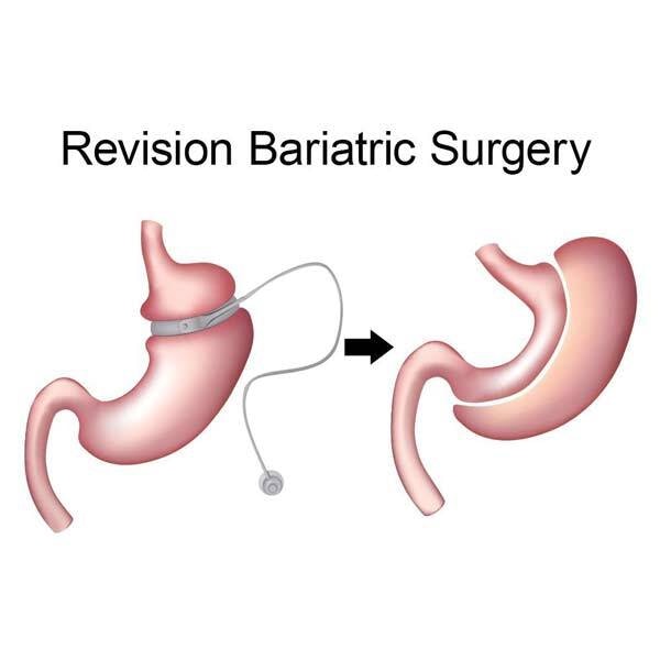 Illustration of Lap-Band surgery