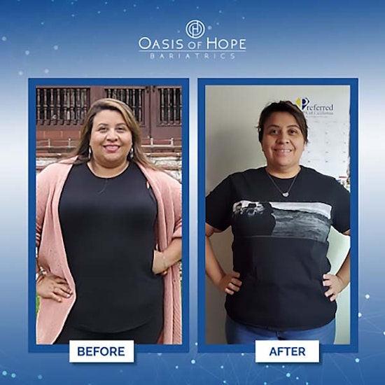 Before and after gastric bypass surgery