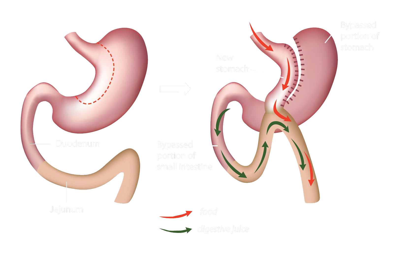 mini-gastric-bypass-tijuana-mexico-oasis-bariatrics