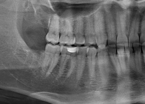 X-ray of mouth before wisdom tooth emergence