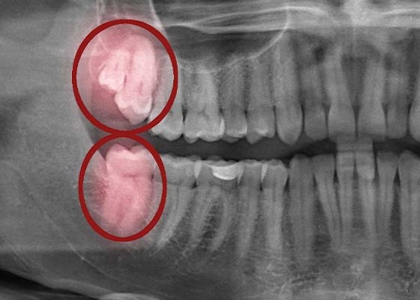 X-ray of mouth after wisdom tooth emergence