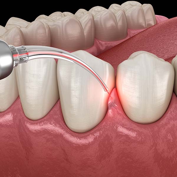 Laser Gum Surgery Illustration